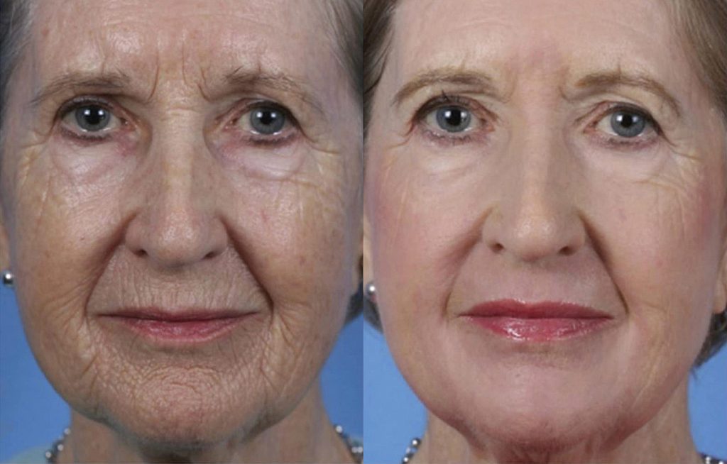 Before and after ContourTRL treatment. Photos courtesy of Sciton.