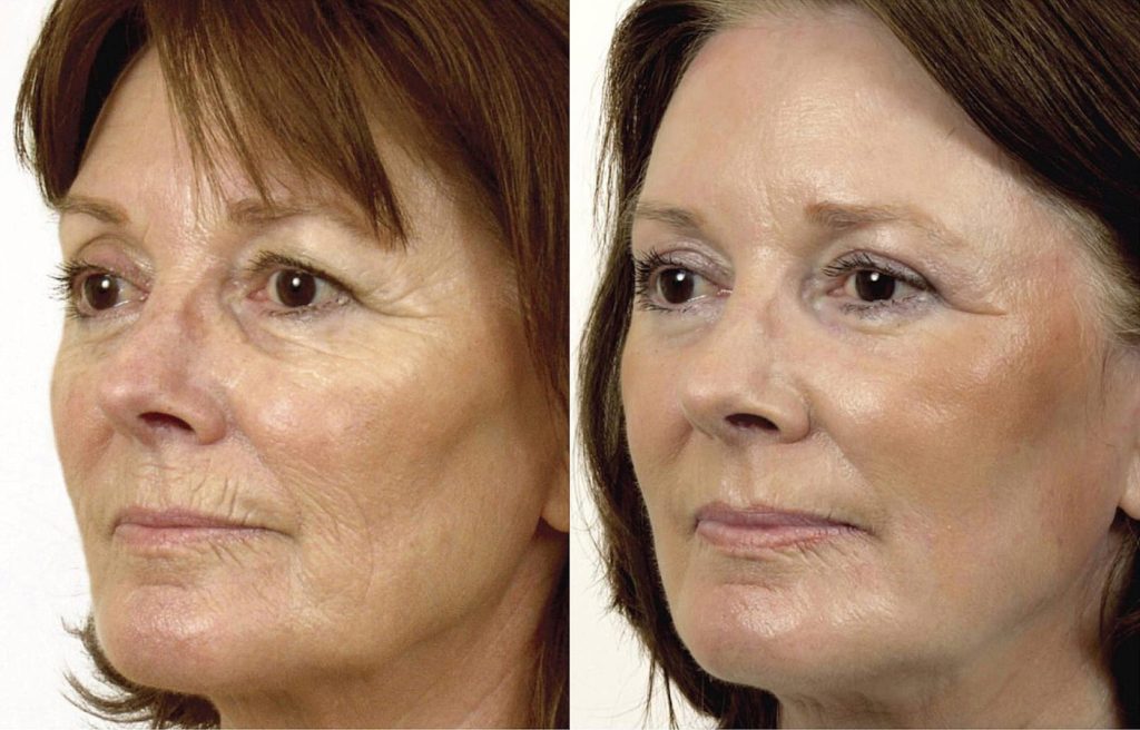 Before and after ContourTRL treatment. Photos courtesy of Sciton.