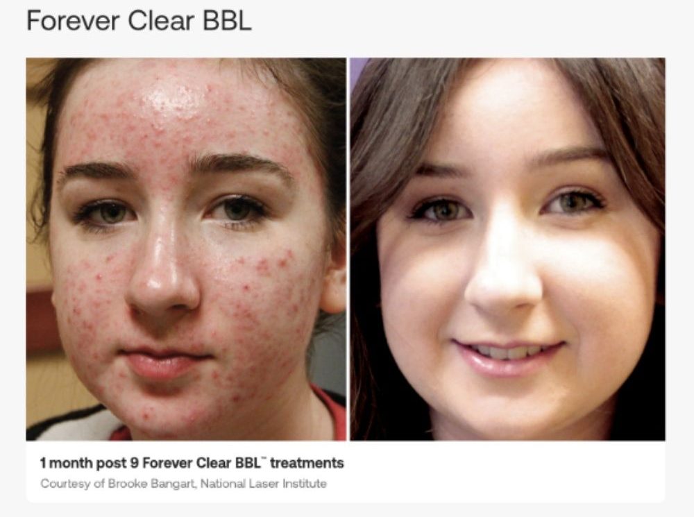 forever clear bbl b&a