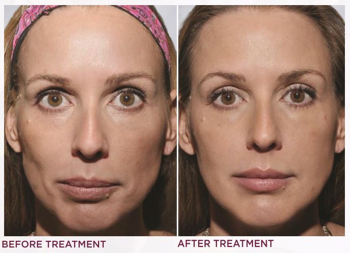 Women before and after Sculptra treatment