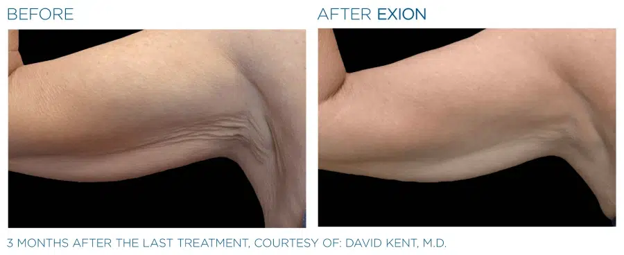 Before and after Exion body treatment.