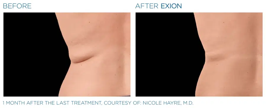 Before and after Exion body treatment.
