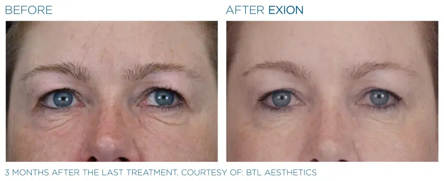 Before and after Exion face treatment.