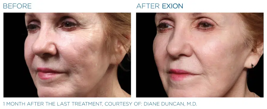 Before and after Exion face treatment.