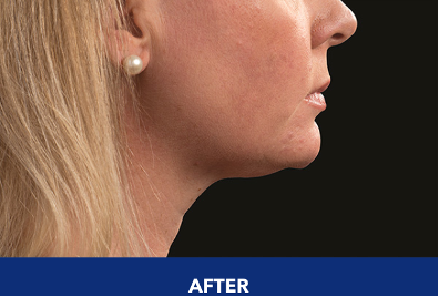 Profile of woman's chin and neck after CoolSculpting treatment.