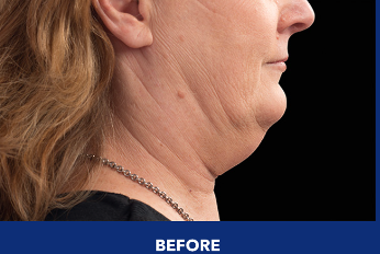 Profile of patient's lower face and neck before CoolSculpting treatment.