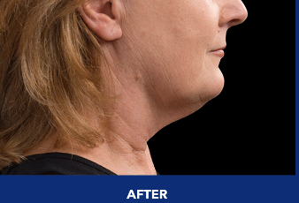 Profile of patient's lower face and neck after CoolSculpting treatment.