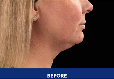 Profile of woman's chin and neck before CoolSculpting treatment.