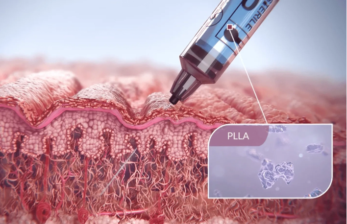 How Sculptra® Aesthetic Works Beneath the Skin
