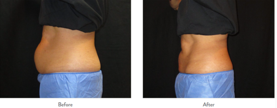 Before and After CoolSculpting (results vary per patient).